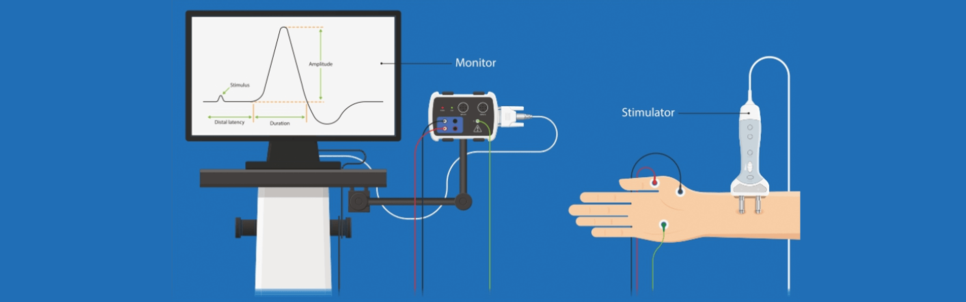 NCS - Nerve Conduction Study
