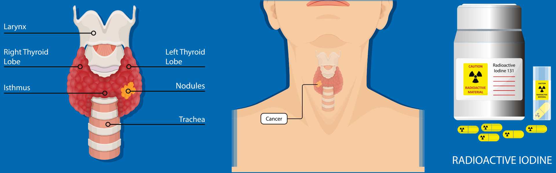 Radioiodine Therapy For Thyroid Cancer in Goa Iodine 131 Therapy For Thyroid Cancer in Goa