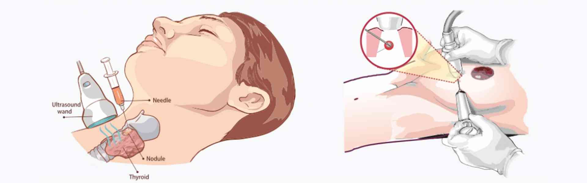Core Biopsy Treatment in Sarjapur Road Bangalore 
