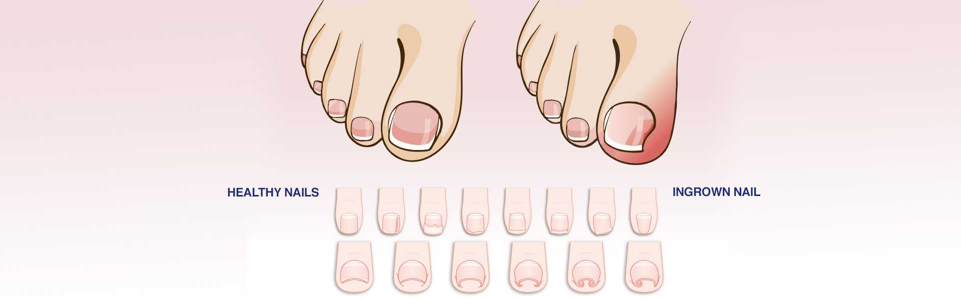 Ingrown Toe Nail Treatment in Bangalore Ingrown Toe Nail Treatment Hospital in Bangalore