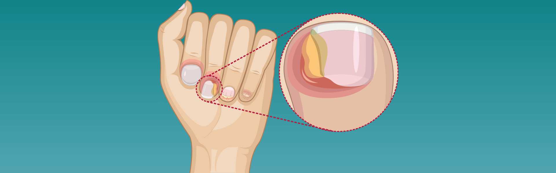 Paronychia Nail Infection Treatment in Bangalore Paronychia Nail Infection Treatment Hospital in Bangalore