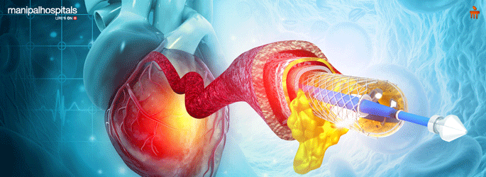 Angioplasty surgery treatment in Bangalore