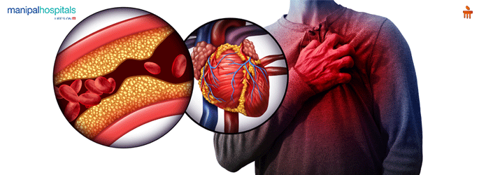 Cardiovascular Disease Treatment in Dwarka Delhi