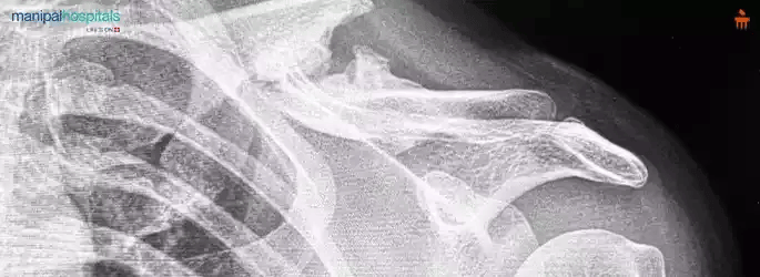 Understanding Union and Malunion Fractures: Causes, Symptoms, and Treatments