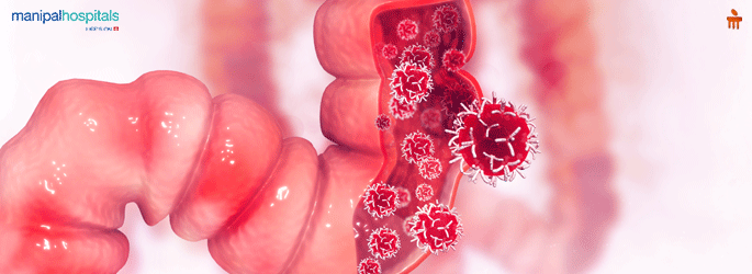 Colon Cancer Treatment in Malleshwaram Colon Cancer Treatment in Malleshwaram Bangalore