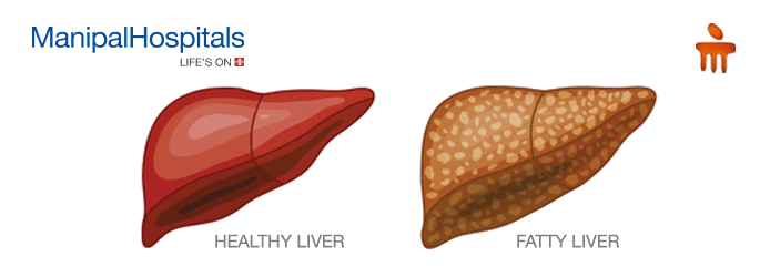 liver hospital in Mangalore