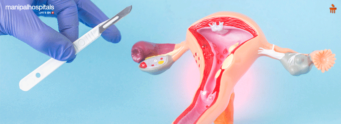 Fibroid Treatment in Hebbal Bangalore