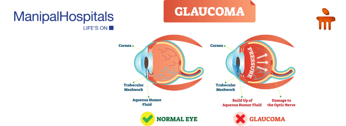 glaucoma treatment in Delhi