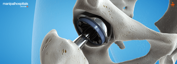 Joint Replacement Surgery In Millers Road Bangalore