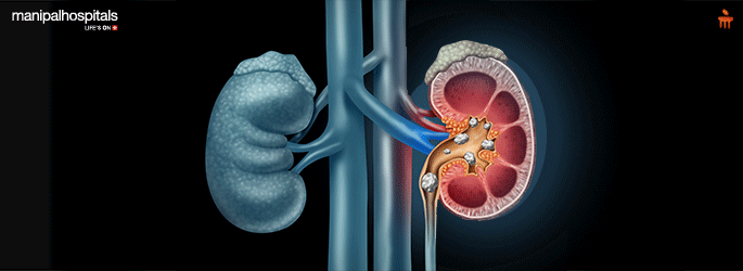 Kidney Stones treatment in Gurugram