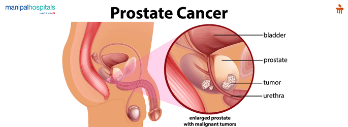 Prostate disease Treatment in Mangalore