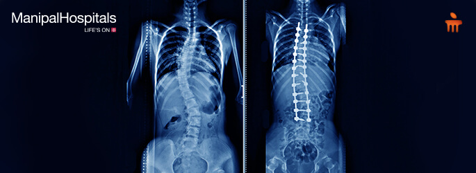best spine surgeon in Delhi