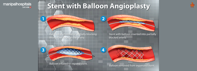 Stent Placement Treatment in Vijayawada