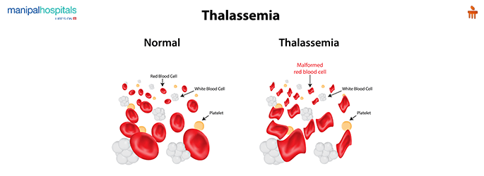 Thalassemia Treatment in Delhi