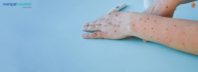 Tomato Flue Treatment in Bangalore