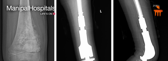 good orthopedic doctor in Bangalore