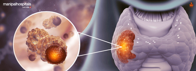 Cancer treatment in Millers Road, Bangalore