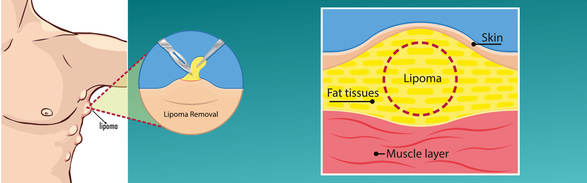 Lipoma Excision | Manipal Hospitals India