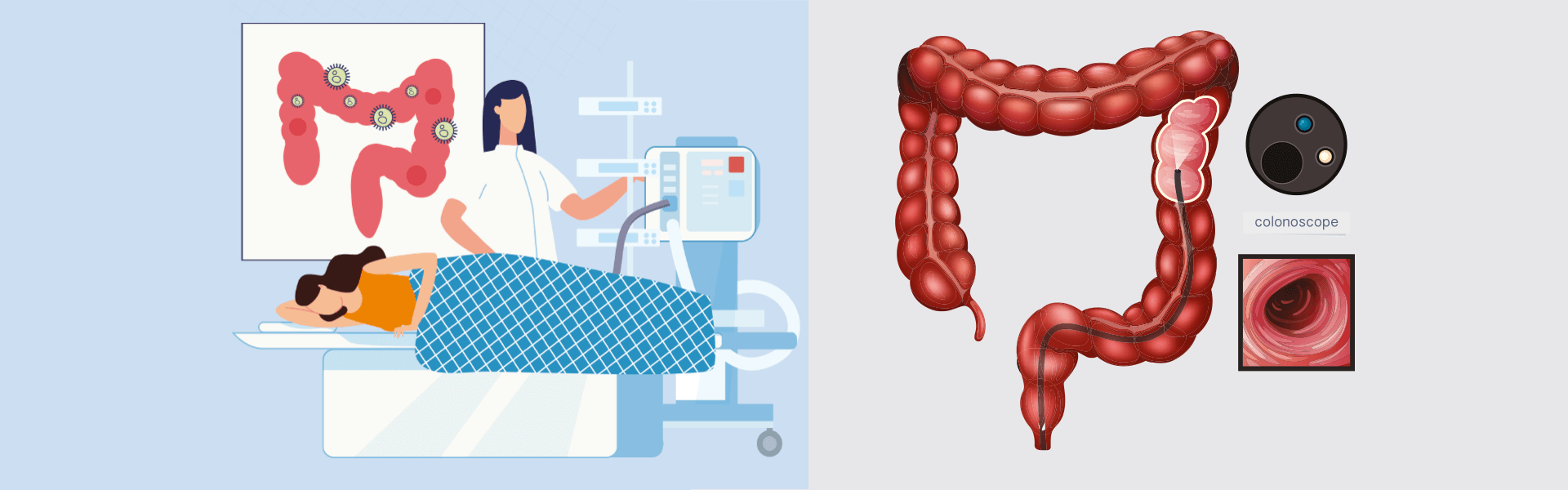 Colonoscopy | Manipal Hospitals India
