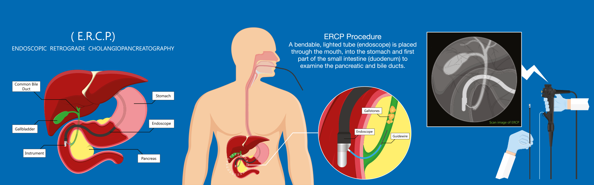 ERCP | Endoscopic Retrograde Cholangiopancreatography in India - Manipal